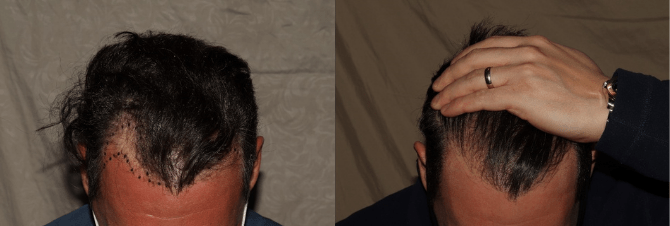 Scar free hair transplant surgery results