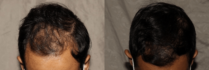 Increased hair volume after hair transplant