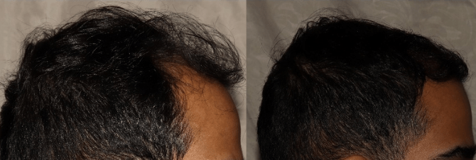 Growth after hair restoration procedure