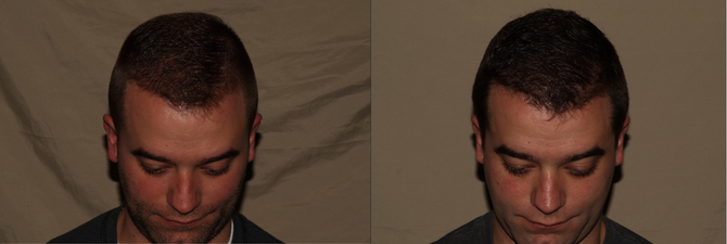 Hair Transplant Philadelphia Before & After