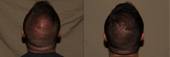 Hair Transplant Philadelphia Before & After