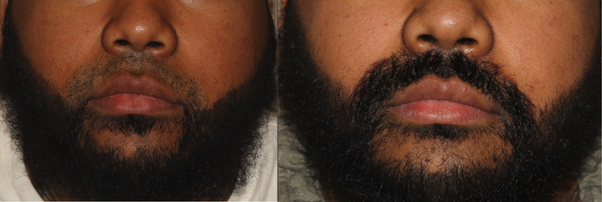 Facial Hair Transplant Philadelphia Before & After