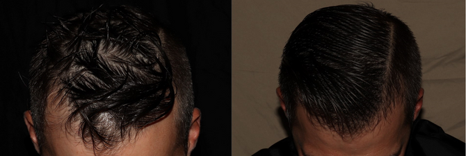 Hair Transplant Philadelphia Before & After