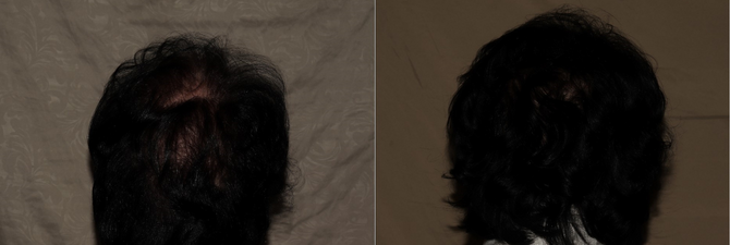 Hair Transplant Philadelphia Before & After