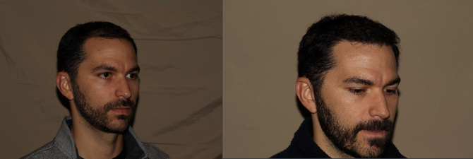 Hair Transplant Philadelphia Before & After