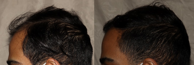 Hair Transplant Philadelphia Before & After