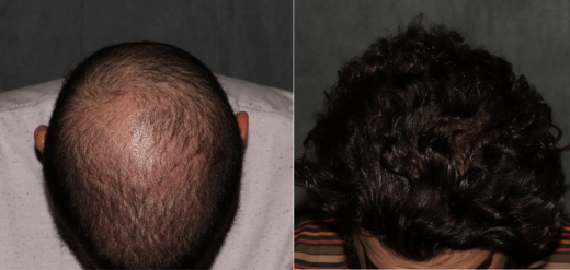 hair transplant before and after