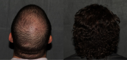 hair transplant before and after crown
