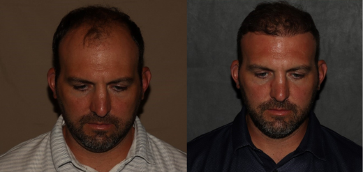 hair transplant before and after