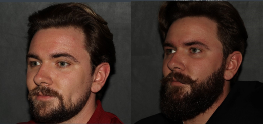 hair transplant before and after beard