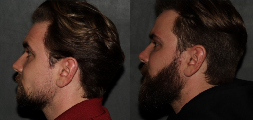 hair transplant before and after facial hair
