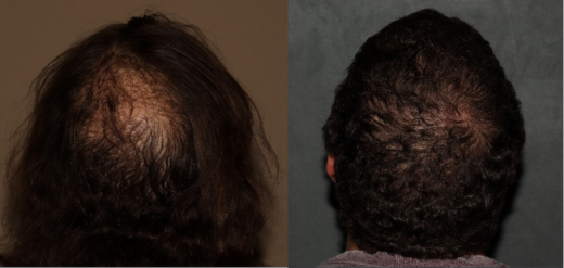 hair transplant before and after crown