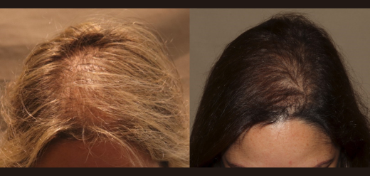 hair transplant before and after female
