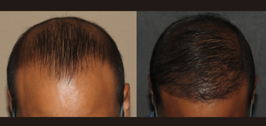 hair transplant before and after frontal hairline
