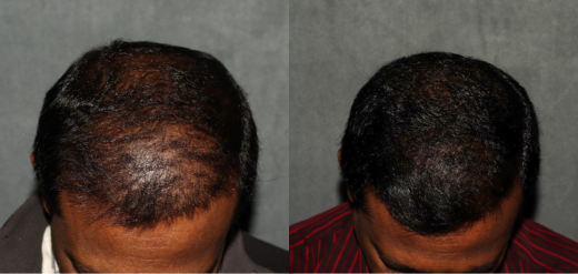 hair transplant before and after receding hairline